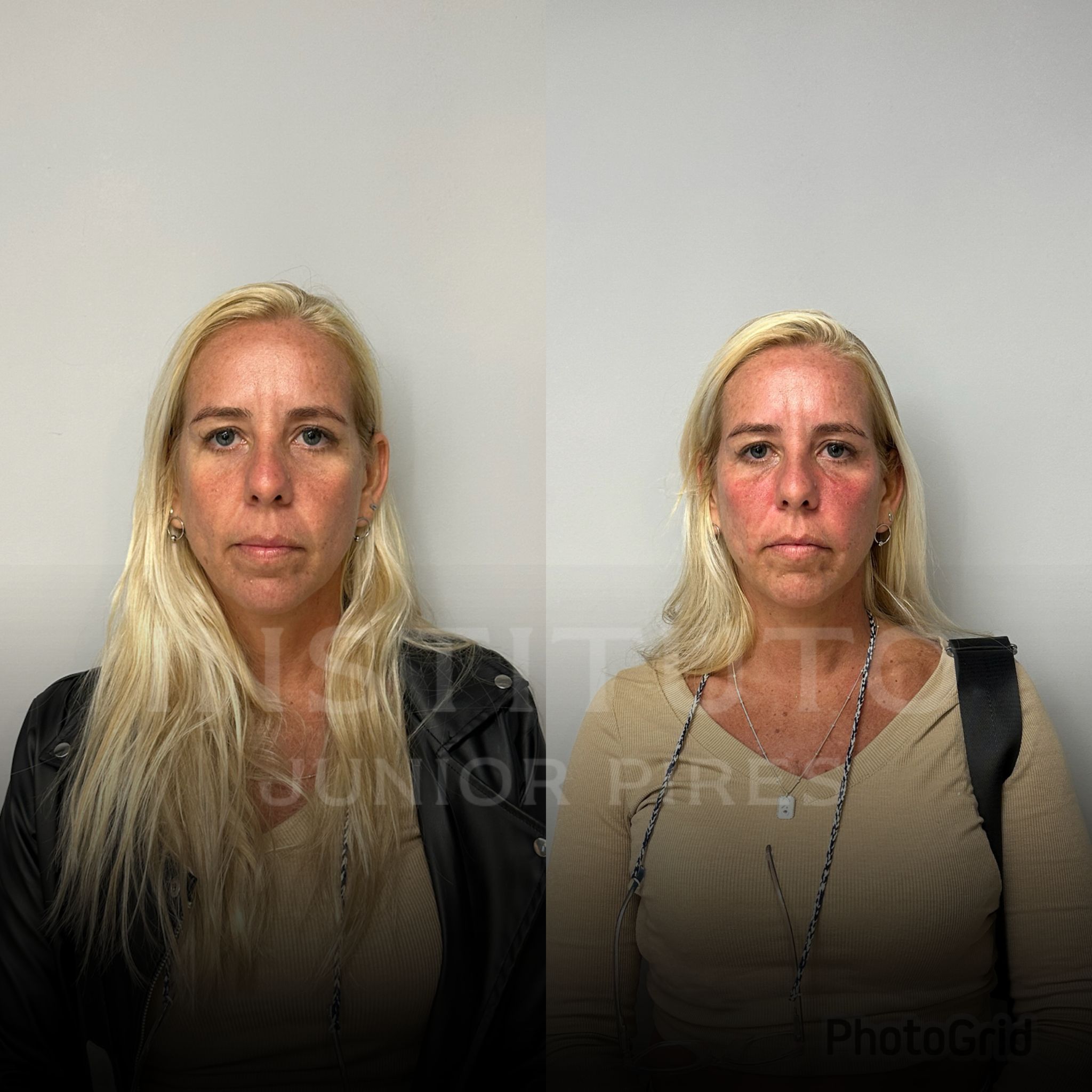 Antes e depois paciente modelo - 101