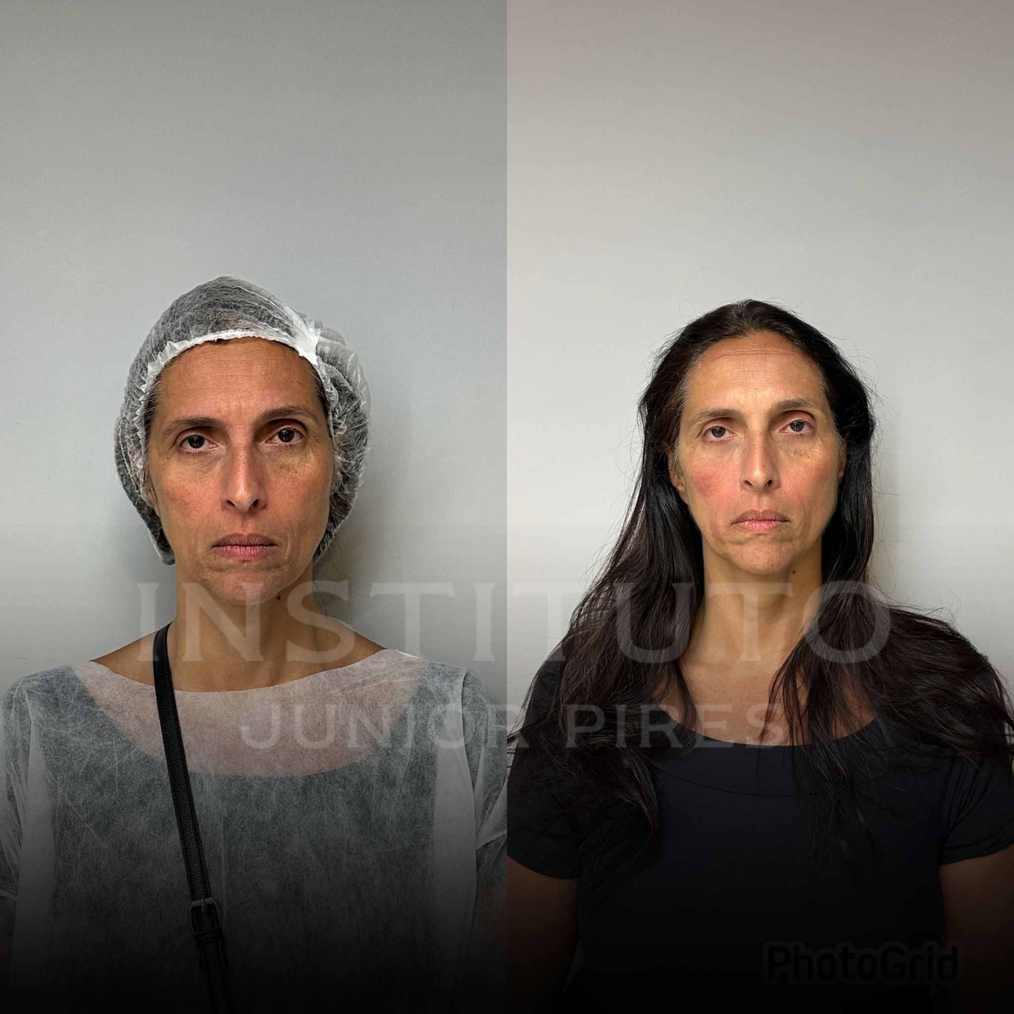 Antes e depois paciente modelo - 111