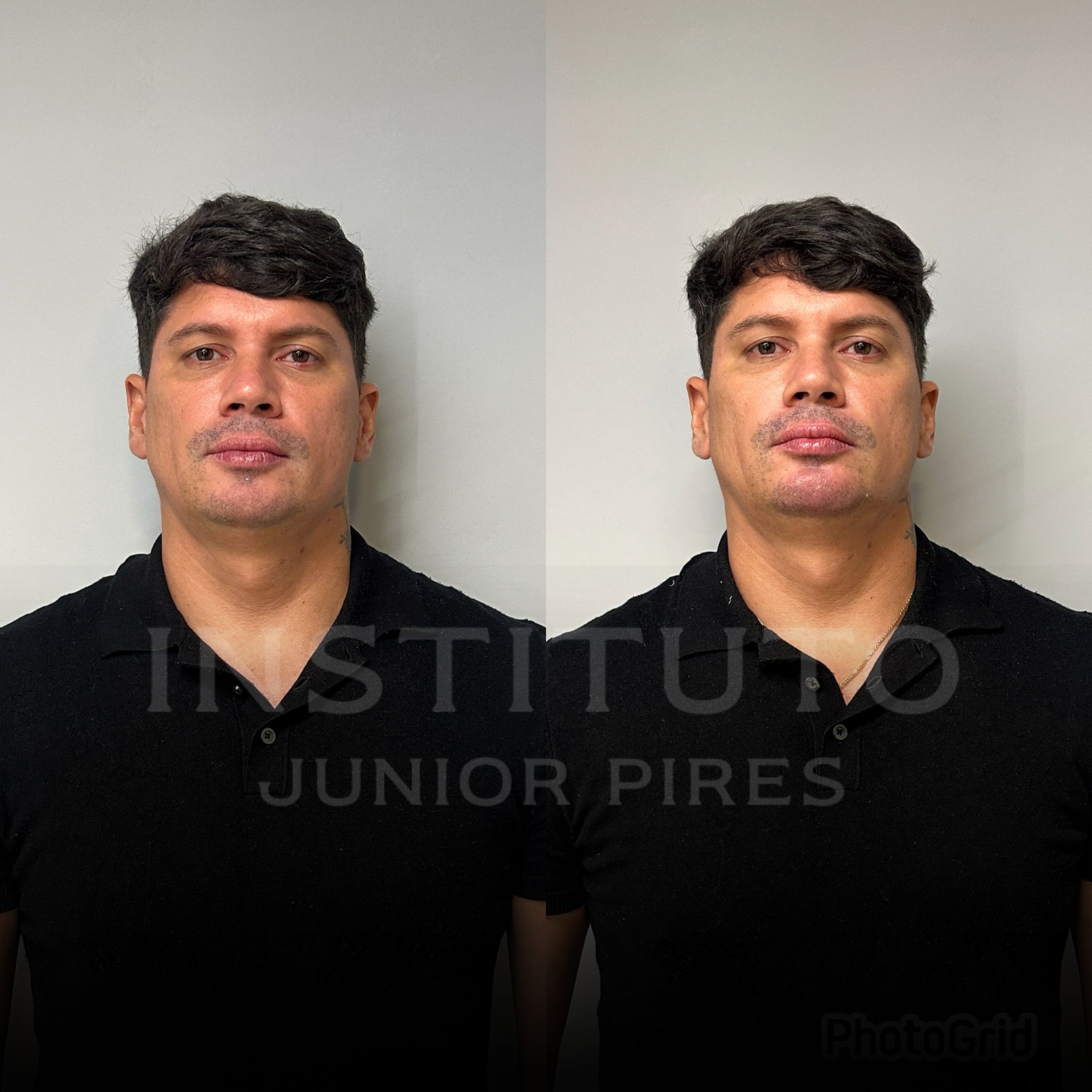 Antes e depois paciente modelo - 97